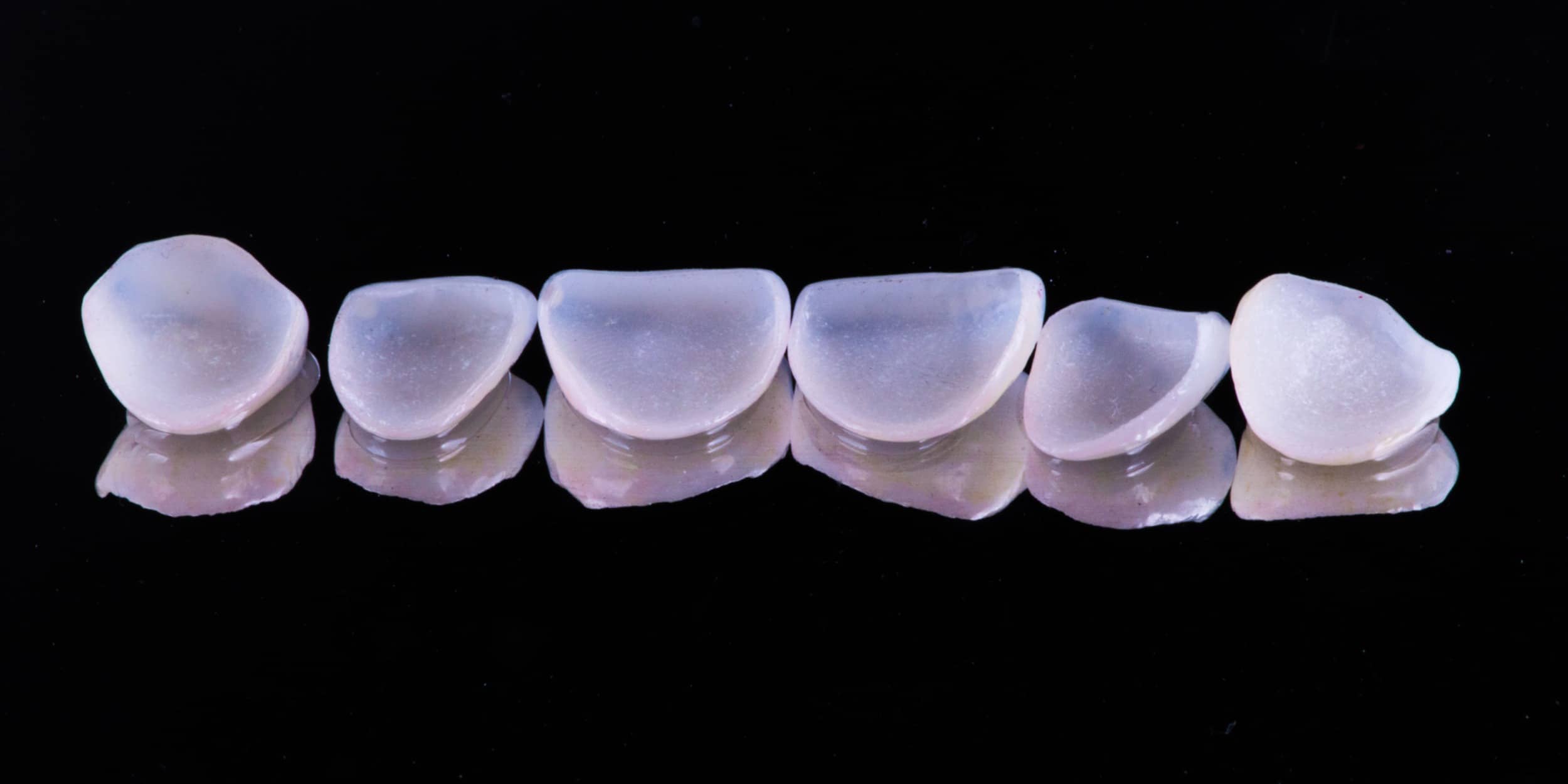 Combien de séances sont nécessaires pour la pose de facettes dentaires ? | Dr Elhyani | Paris