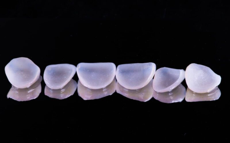 Combien de séances sont nécessaires pour la pose de facettes dentaires ? | Dr Elhyani | Paris