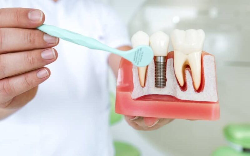 Tout savoir sur la pose d’implant dentaire | Dr Elhyani | Paris