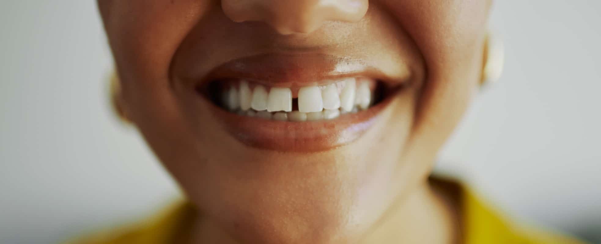 Corriger les dentes du bonheur à Paris avec le Dr Elhyani