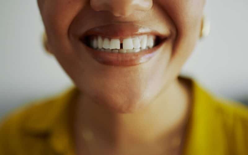 Corriger les dentes du bonheur à Paris avec le Dr Elhyani