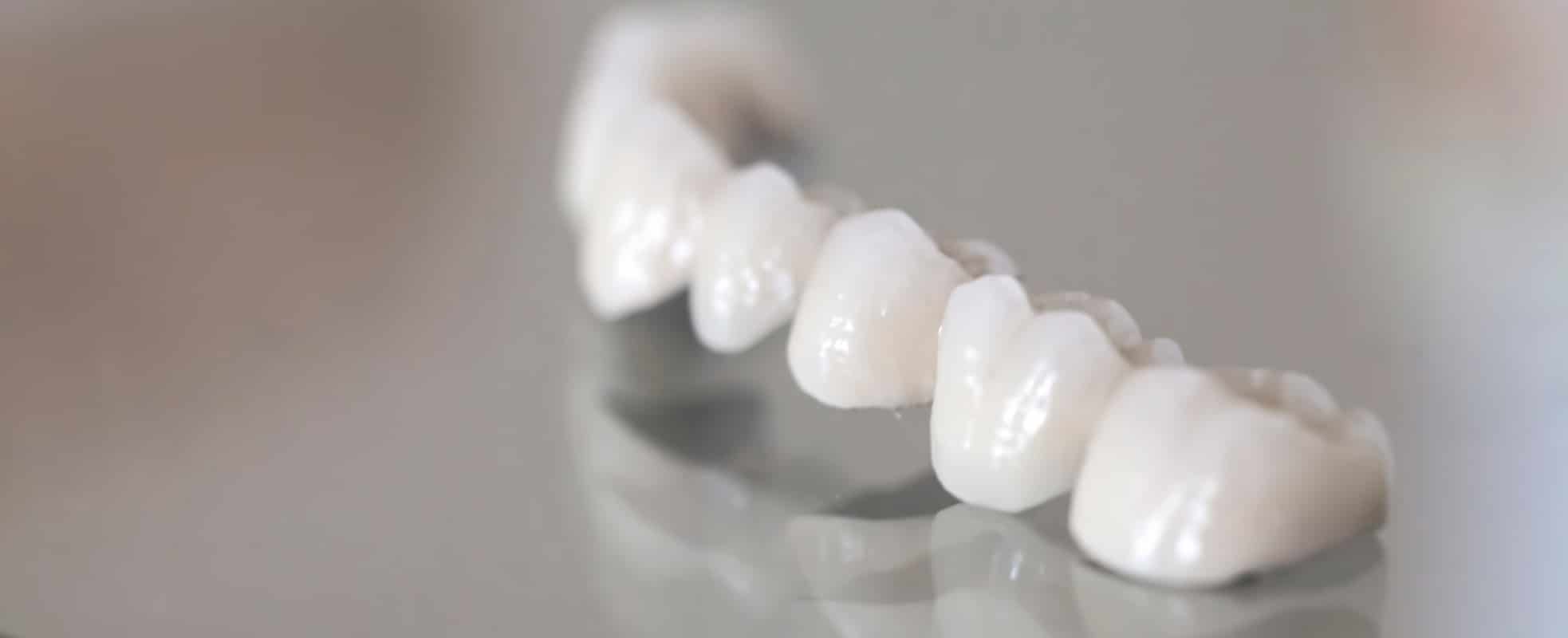 Choisir entre bridge ou bridge sur implant à Paris avec le Dr Elhyani