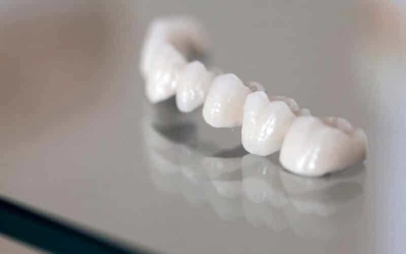 Choisir entre bridge ou bridge sur implant à Paris avec le Dr Elhyani