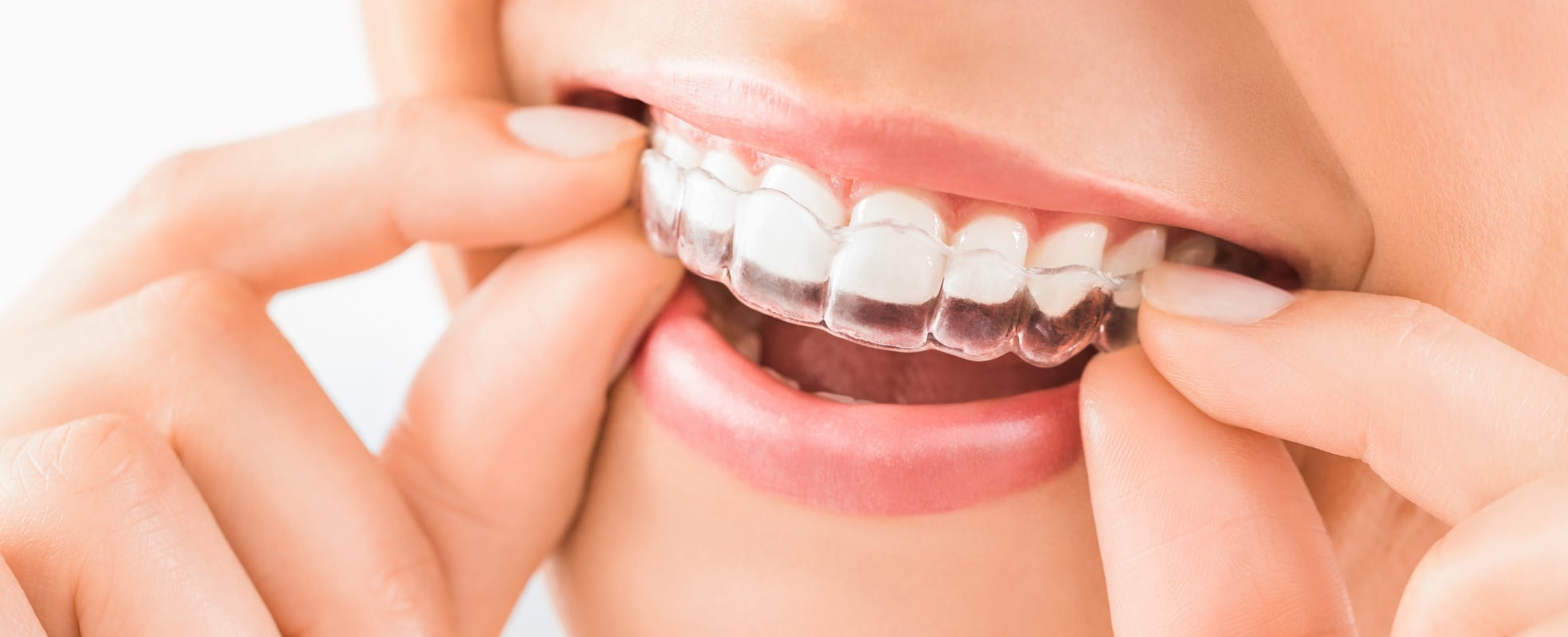 Le Dr Elhyani à Paris vous explique dans quels cas l’Invisalign est recommandé