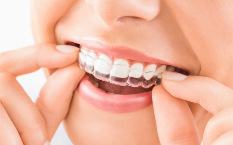 Le Dr Elhyani à Paris vous explique dans quels cas l’Invisalign est recommandé