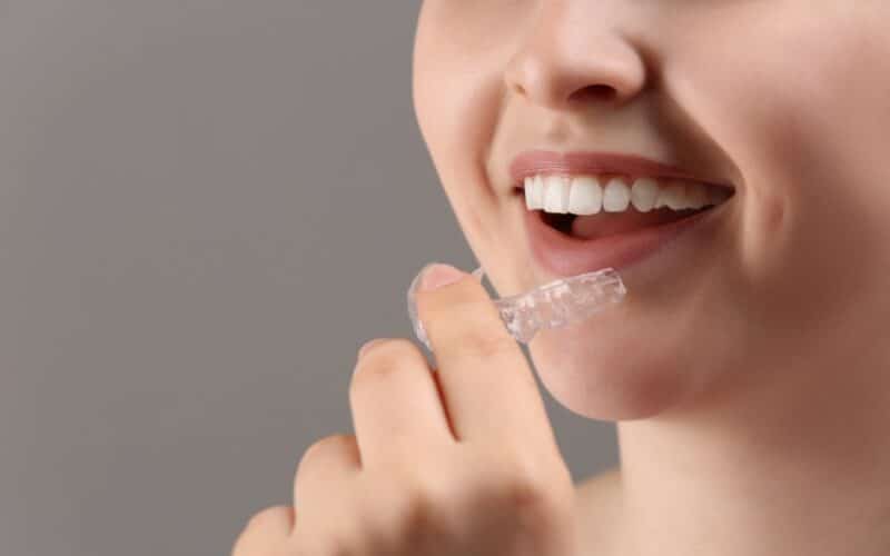 Le Dr Elhyani à Paris vous présente le traitement Invisalign