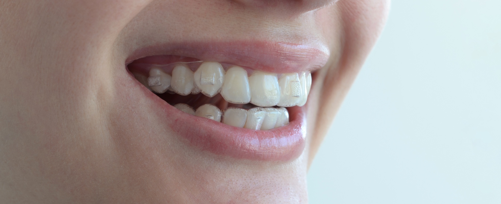 Avantages invisalign