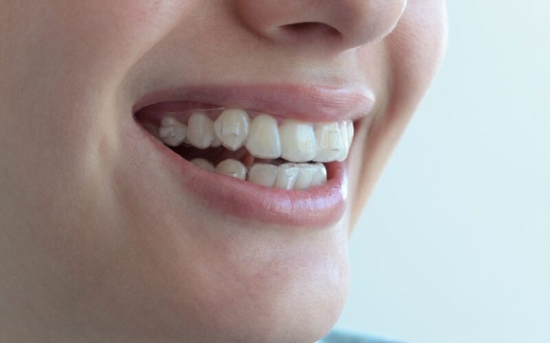 Avantages invisalign