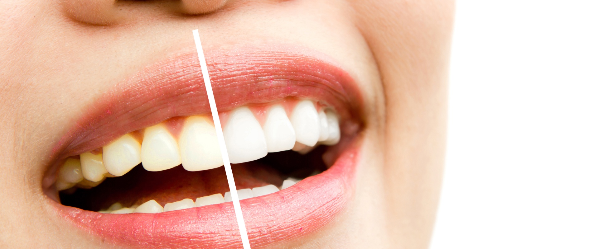 Facettes dentaires et blanchiment