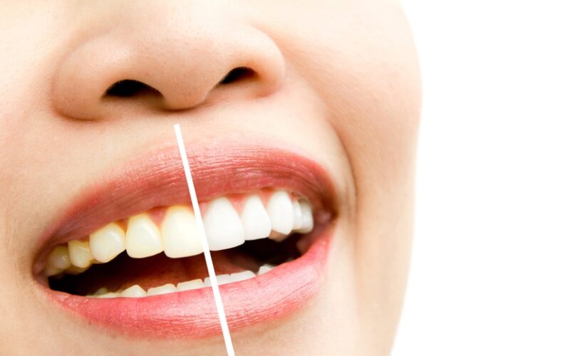 Facettes dentaires et blanchiment