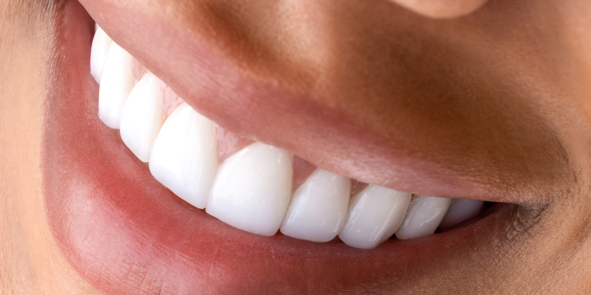 Refaire dents